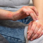 Egzama Nedir? Neden Olur?