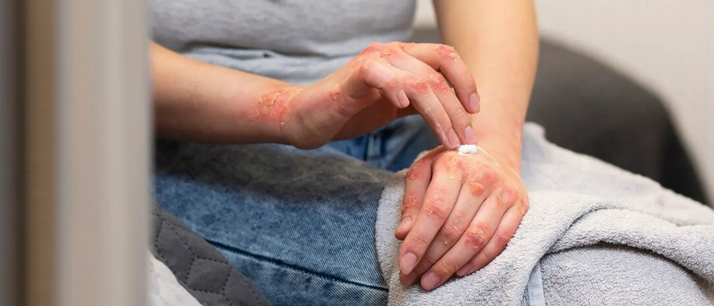 Egzama Nedir? Neden Olur?